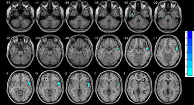 Structural Deficits in the Frontotemporal Network Associated With Psychopathic Traits in Violent Offenders With Schizophrenia